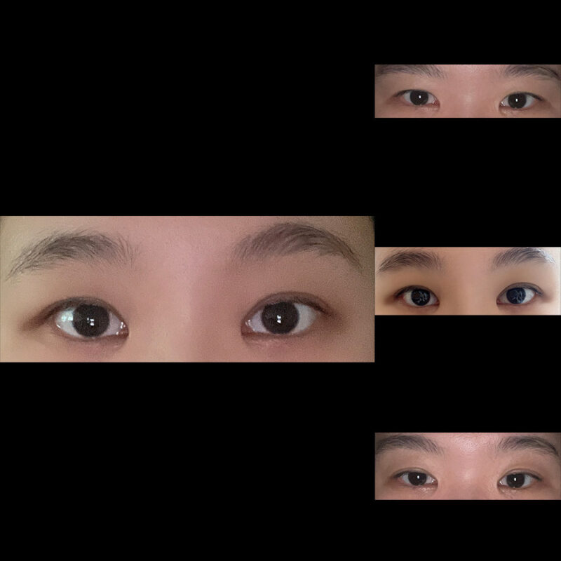 #이마거상#내시경이마거상술