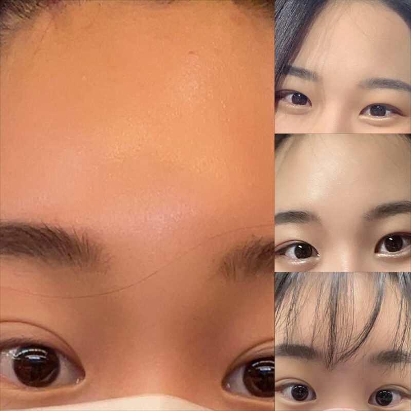 #이마거상#내시경이마거상술