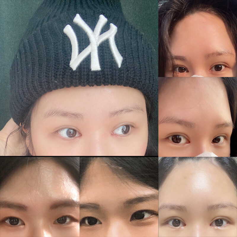 #이마거상#내시경이마거상술