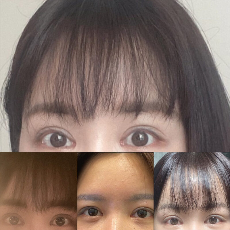 #이마거상#내시경이마거상술