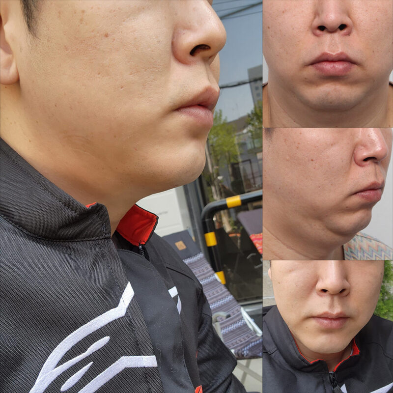 #미드업리프팅#턱끝전진