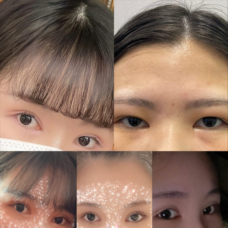 #이마거상#내시경이마거상술