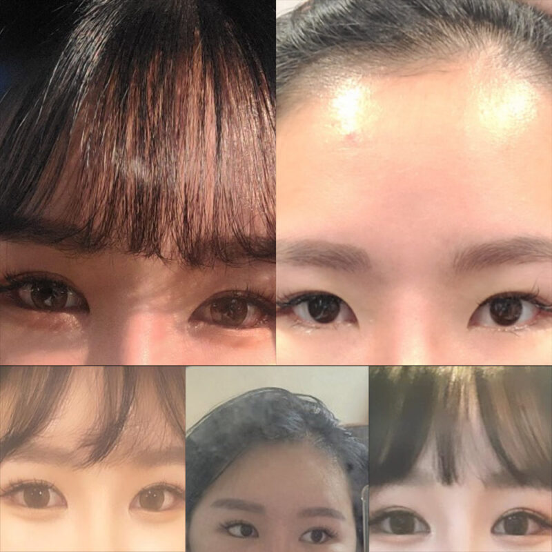 #이마거상#내시경이마거상술