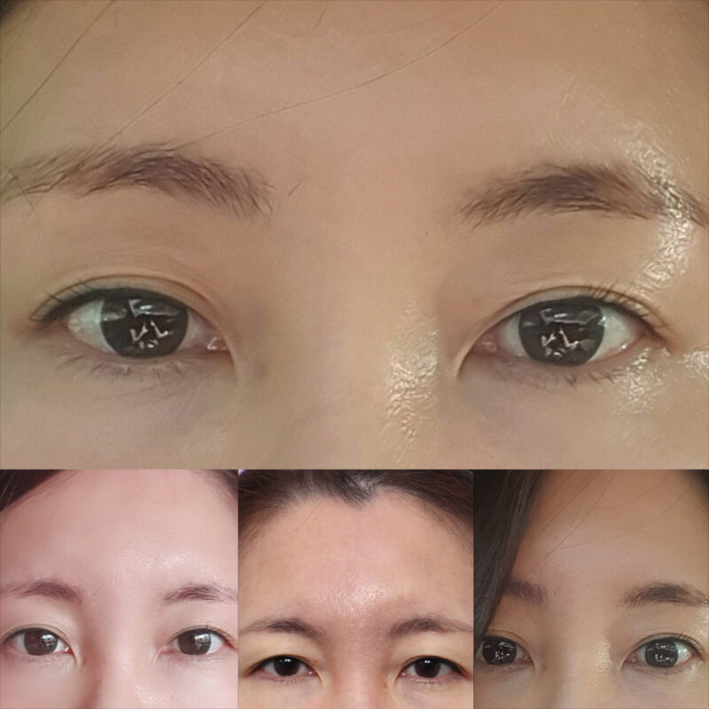 #이마거상#내시경이마거상