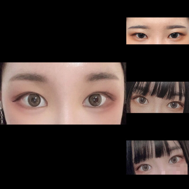 #이마거상#내시경이마거상