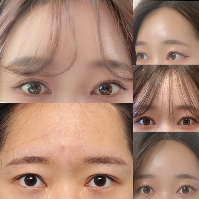 #이마거상#내시경이마거상