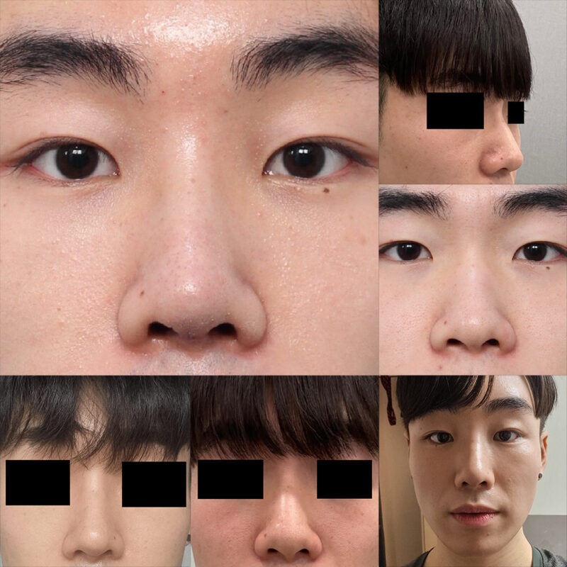 #이마거상#내시경이마거상#코#남자성형