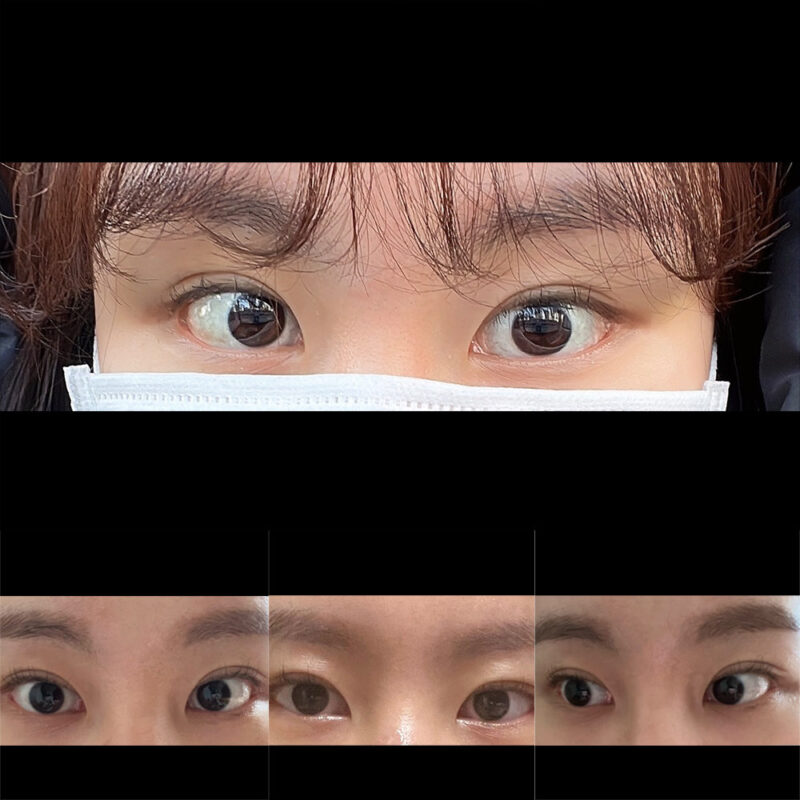 #이마거상#내시경이마거상