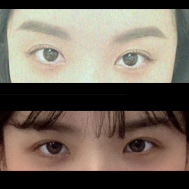 #이마거상#내시경이마거상