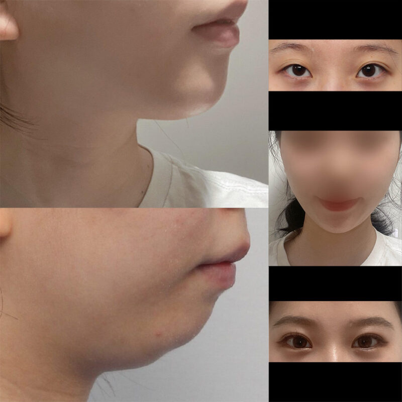 #턱끝전진#자연유착#눈매교정#뒤트임