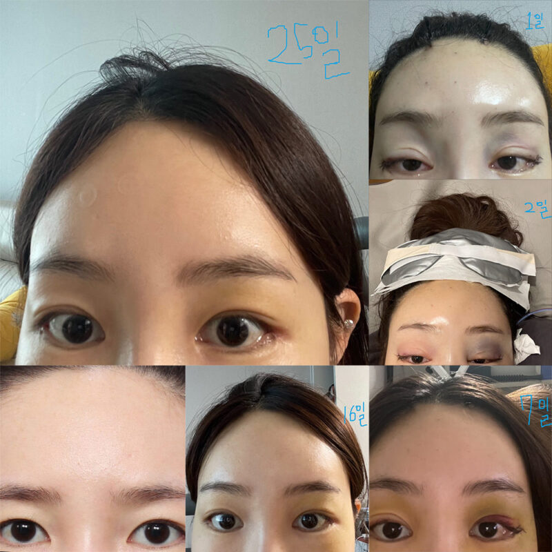#이마거상#내시경이마거상#뒤트임
