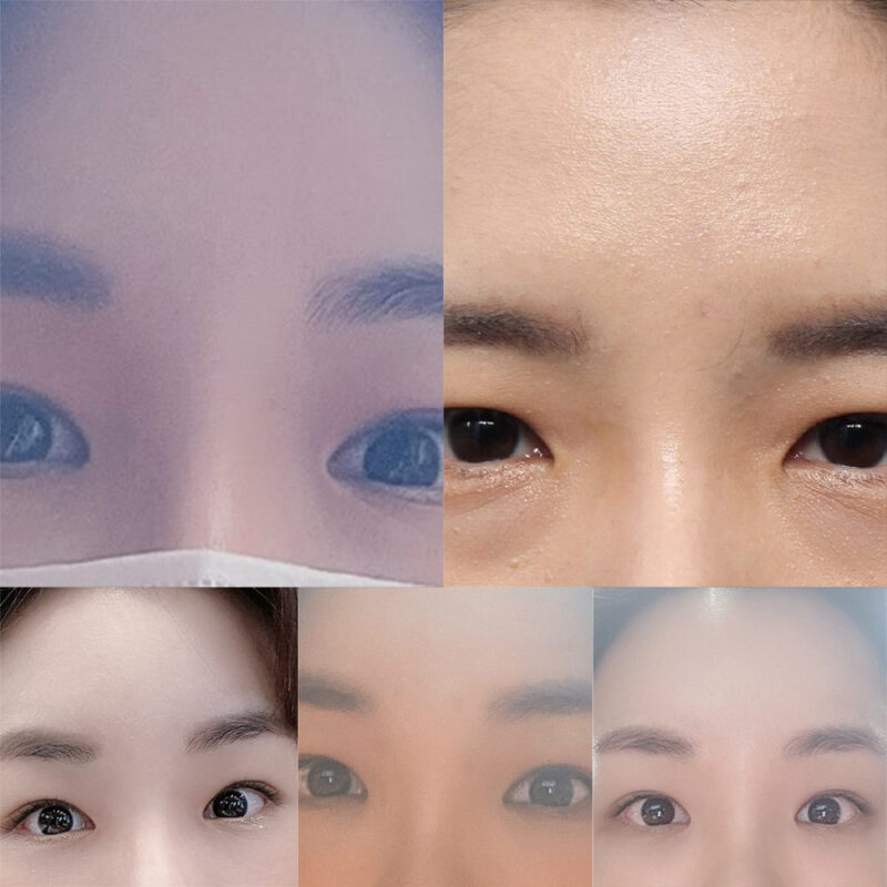 #이마거상#내시경이마거상#눈밑지방재배치#눈밑지방이식#앞광대지방이식