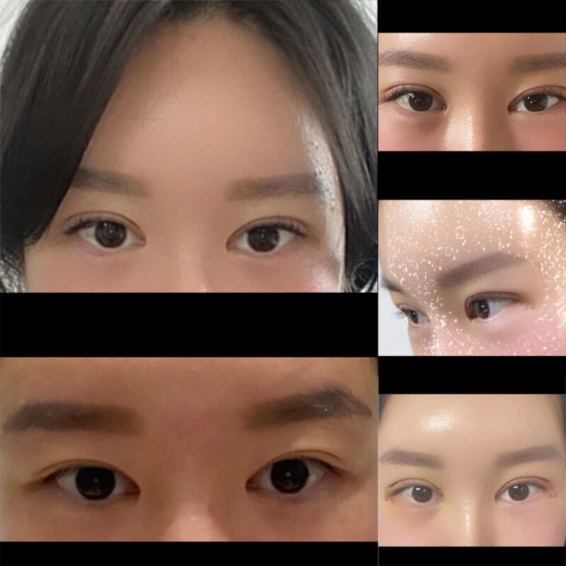 #이마거상#내시경이마거상#절개#눈매교정