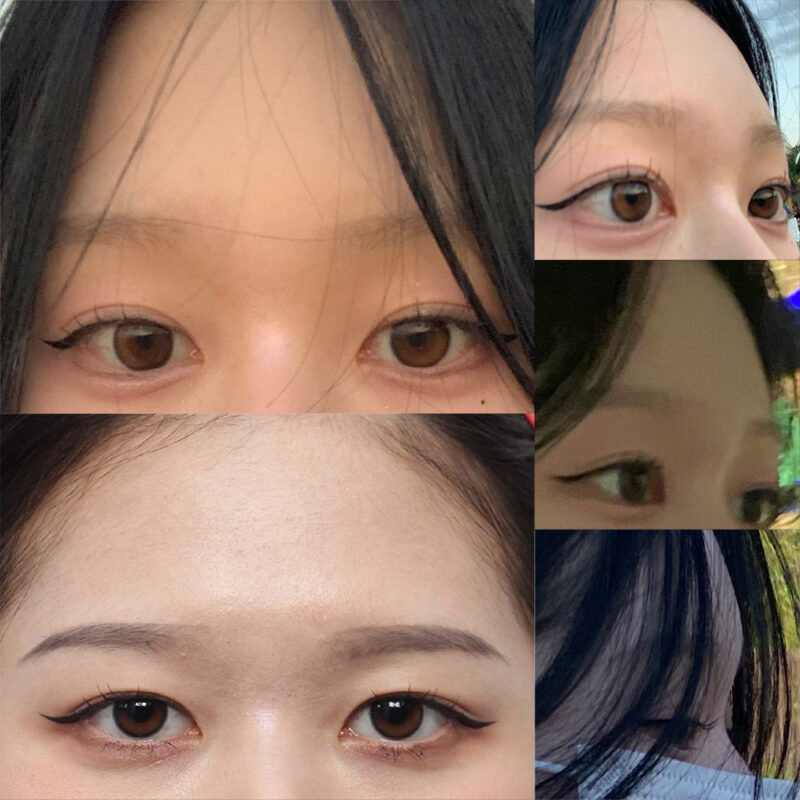 #이마거상#내시경이마거상