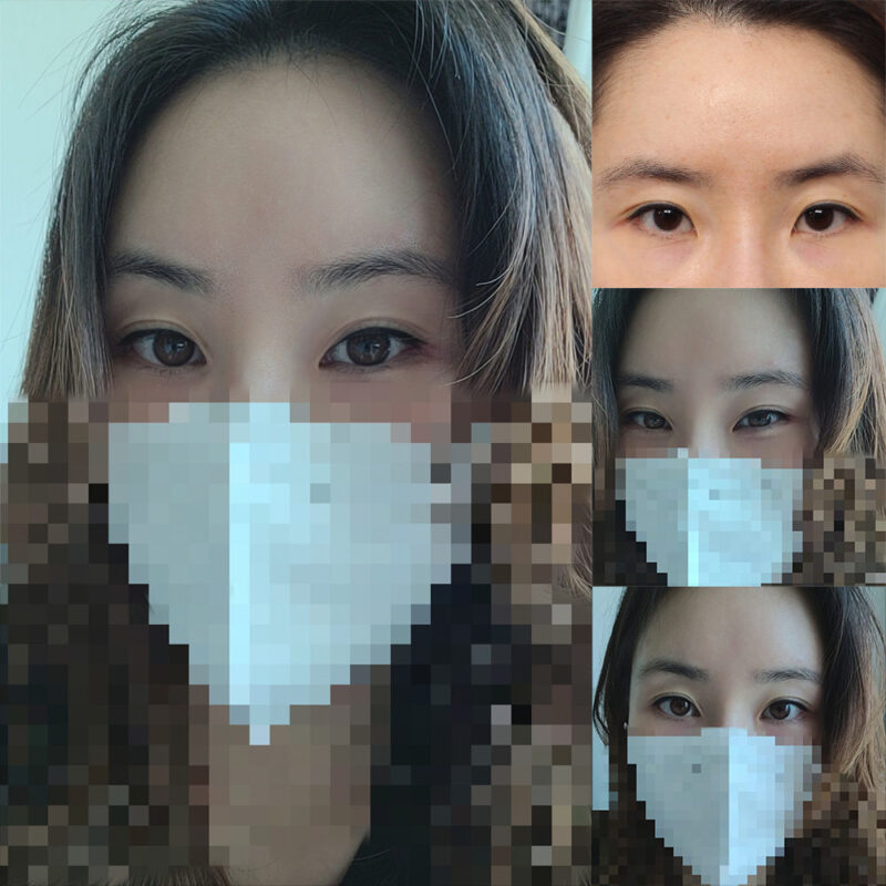 #이마거상#내시경이마거상술#하안검#눈밑지방이식#앞트임#뒤트임