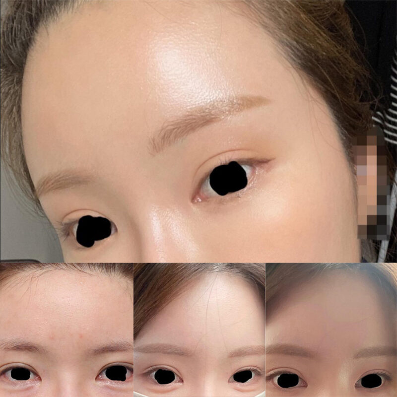 #이마거상#내시경이마거상#눈밑지방재배치,눈밑지방이식