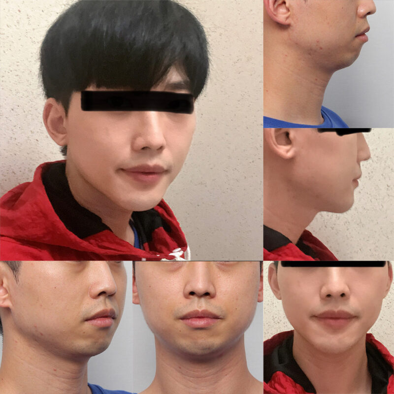 #턱끝전진#눈밑지방재배치
