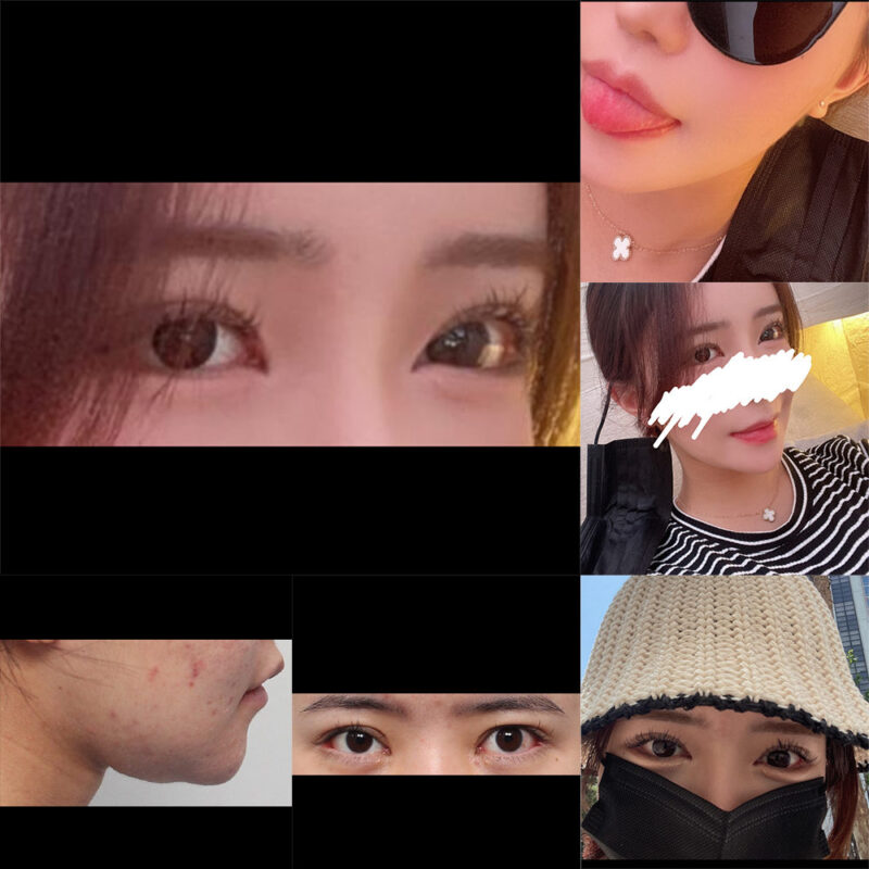 #이마거상#내시경이마거상술#밑트임#뒷트임#턱끝전진#이중턱,턱선지방흡입