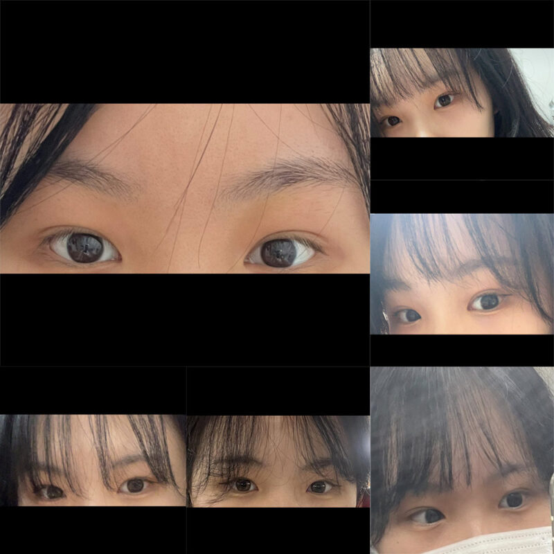 #이마거상#내시경이마거상