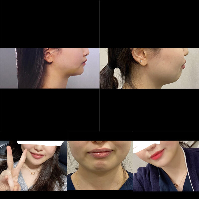 #턱끝전진#2040미드업리프팅