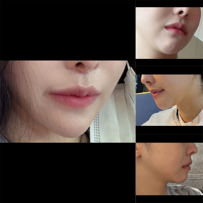 #턱끝전진#2040미드업리프팅
