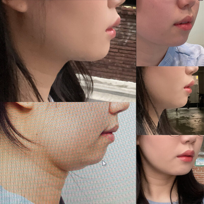 #턱끝전진