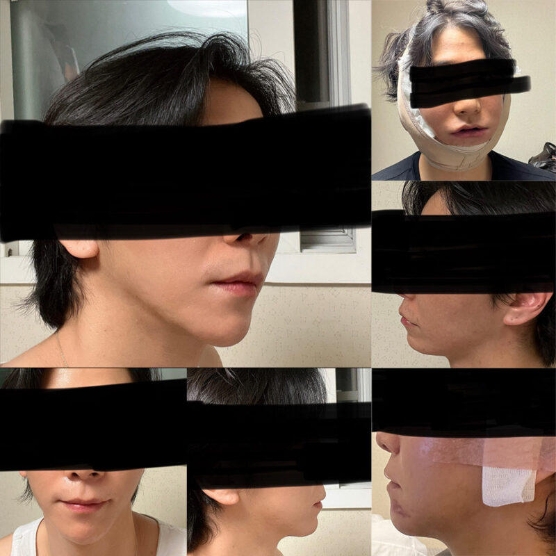 #턱끝전진#무턱보형물제거#5060미드업리프팅#지방흡입(이중턱,턱선,팔자 위)