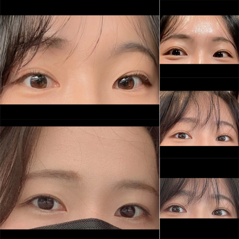 #2040이마거상#내시경이마거상술