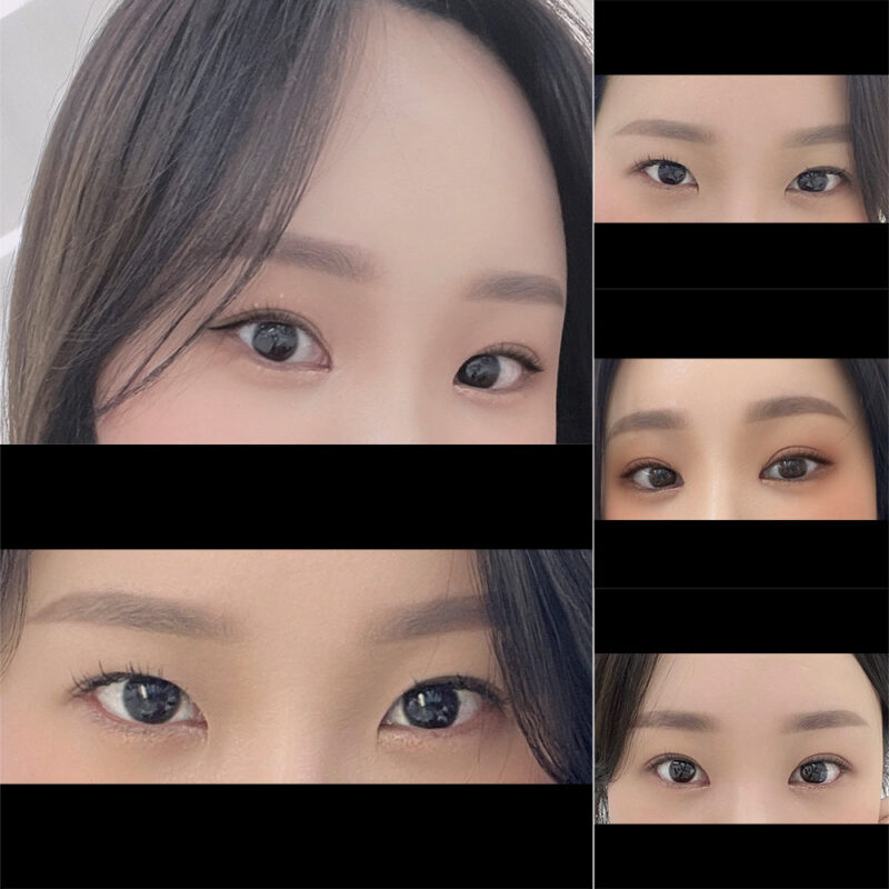 #2040이마거상#앞트임