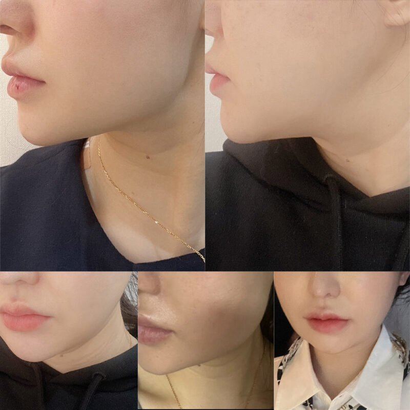 #사각턱축소#5060미드업리프팅#보톡스(사각턱)