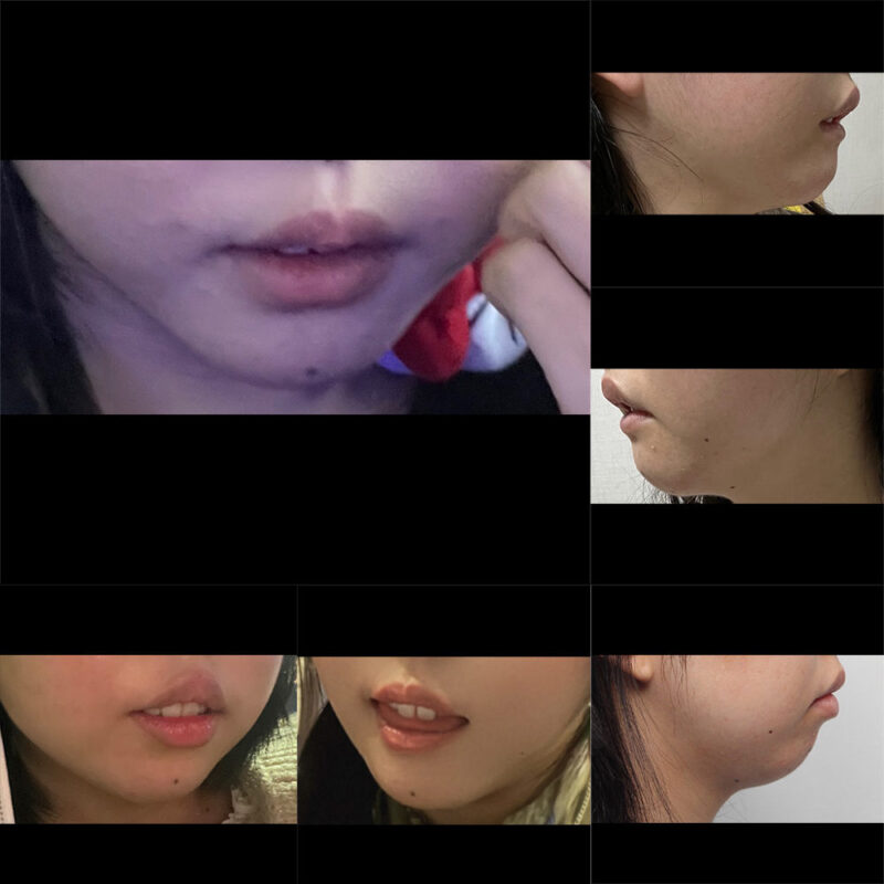 #턱끝전진#2040미드업리프팅