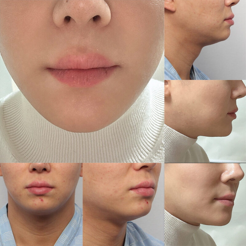 #턱끝전진#무턱보형물제거