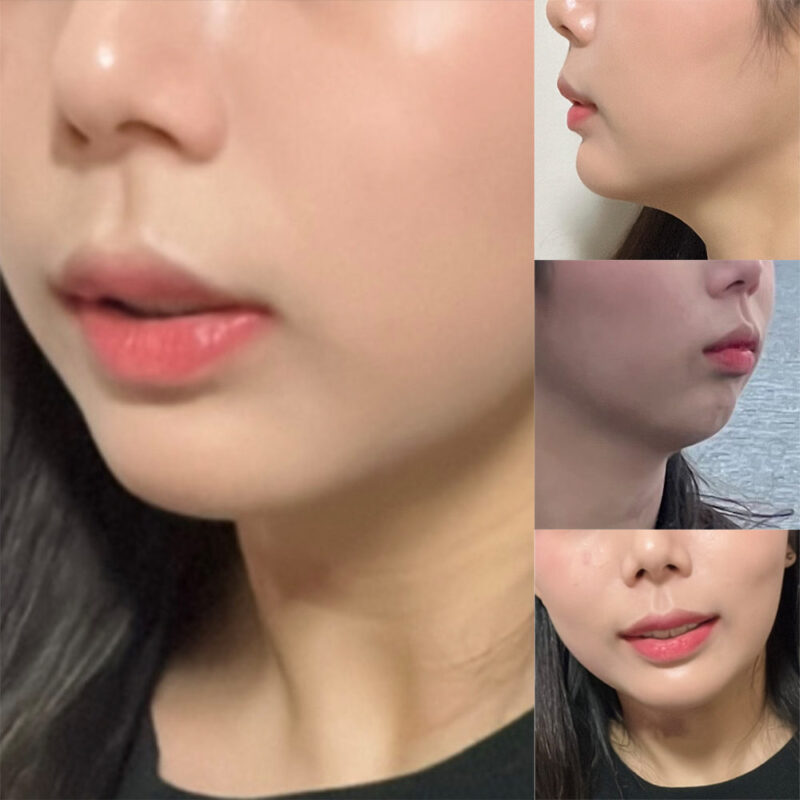 #턱끝전진#보톡스(자갈턱)