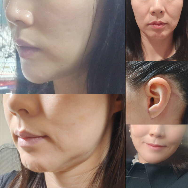 #안면목거상#보톡스(침샘,자갈턱)