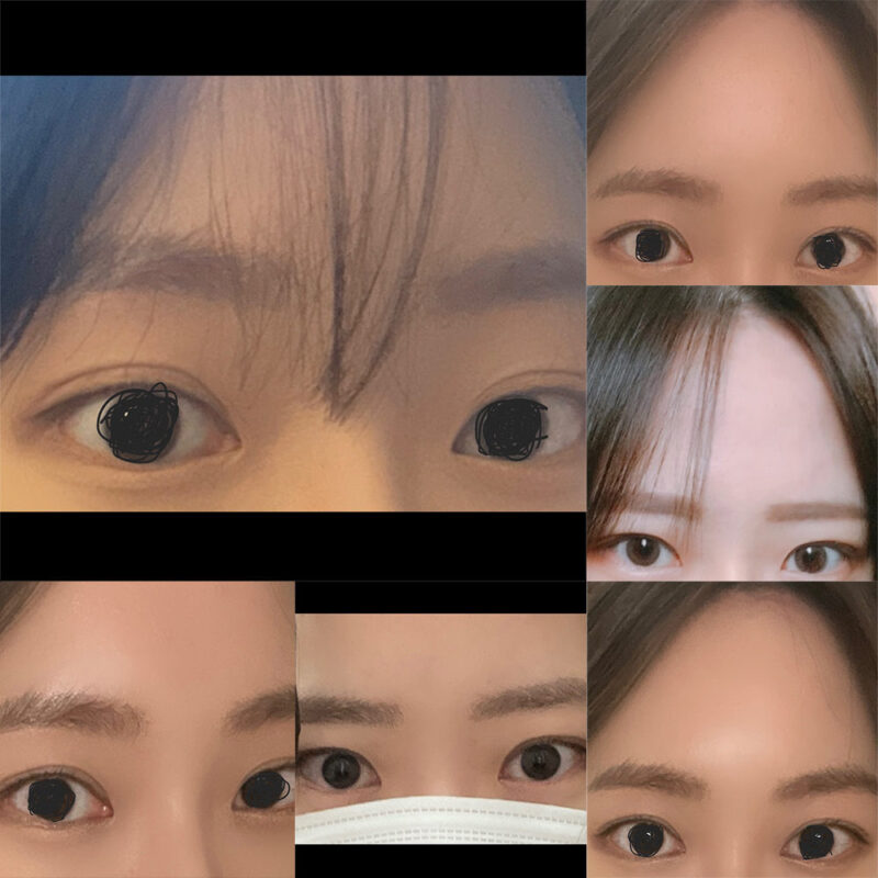 #2040이마거상 #이마축소