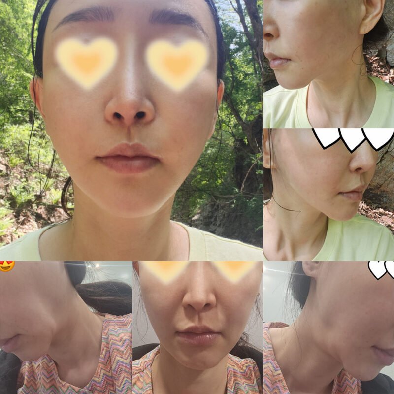 #안면거상(목) #지방이식(얼굴) #앞광대보혀물제거 #보톡스(자갈턱,침샘)