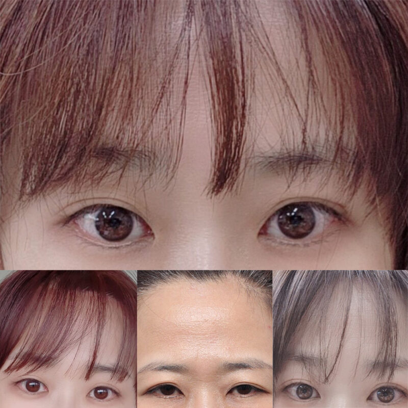 #5060이마거상, 이마축소