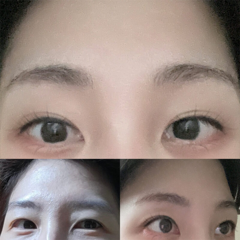 #2040이마거상, 눈썹뼈절삭, 눈밑지방재배치, 지방이식(눈밑)