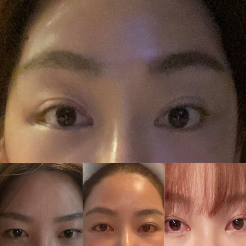 #2040이마거상, 눈밑지방재배치, 지방이식(눈밑)