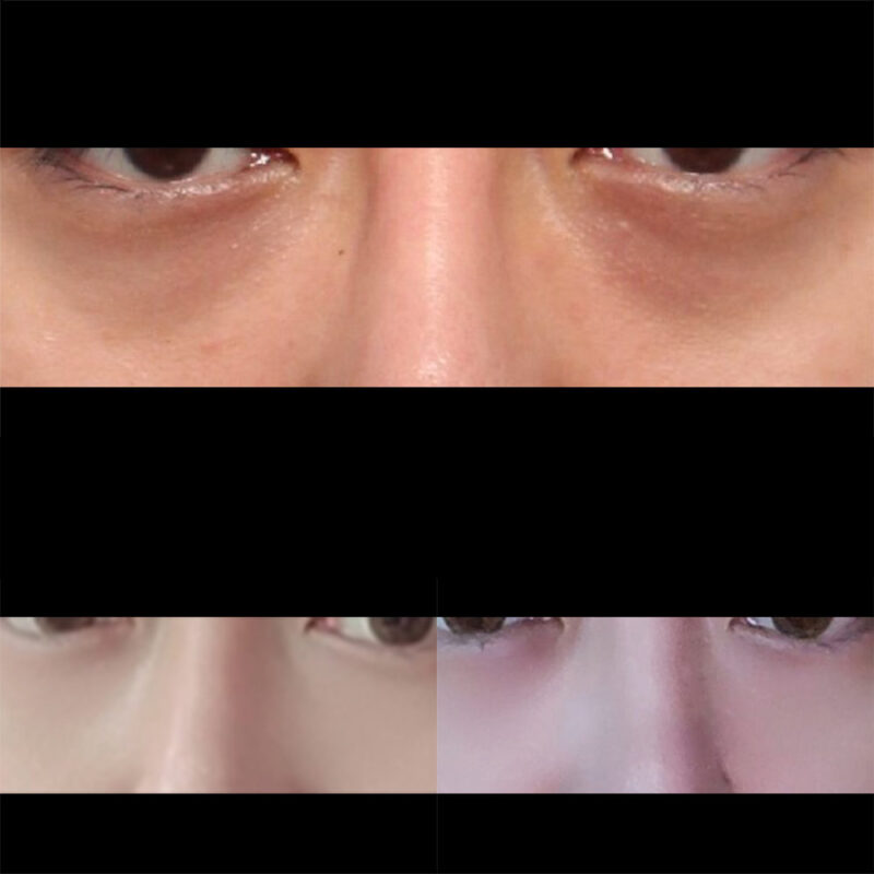 #눈밑지방재배치 #지방이식(눈밑)