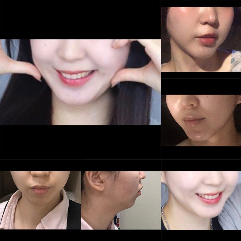 #기능턱전진