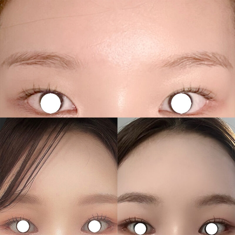 #2040이마거상 #앞트임(재) #뒤트임