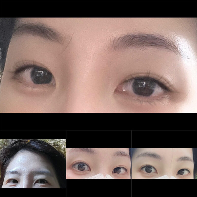 #2040이마거상 #눈썹뼈절삭 #눈밑지방재배치 #눈밑지방이식