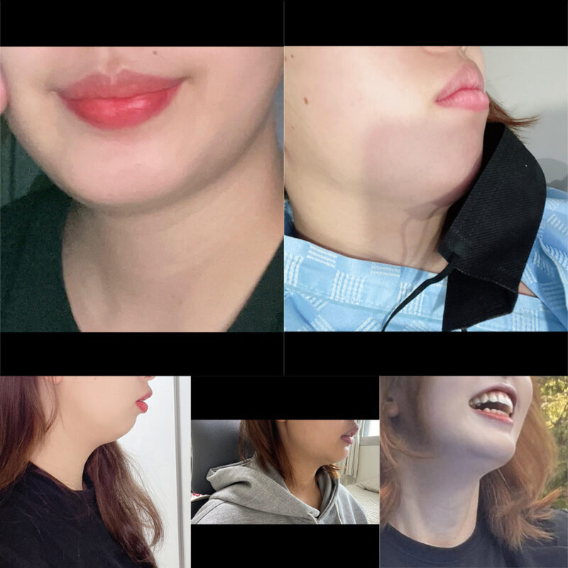#턱끝전진