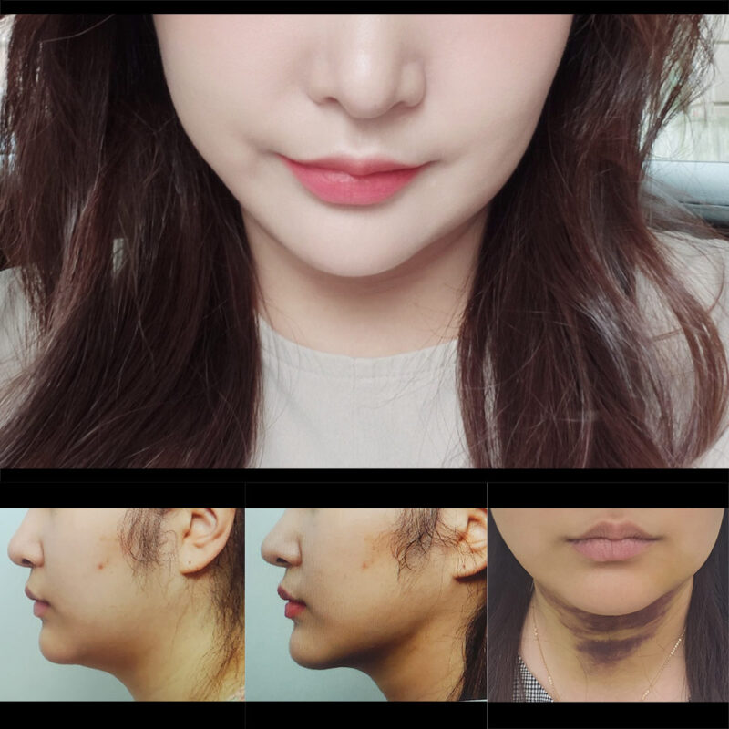 #2040미드업리프팅#지방이식(이마,관자)