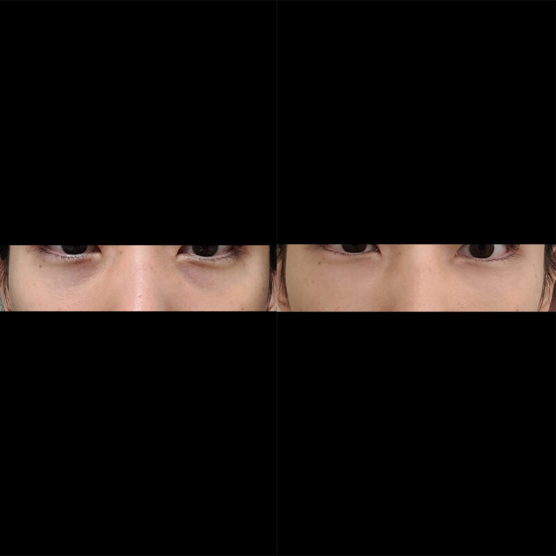 #눈밑지방재배치#지방이식(눈밑,눈위,입술)