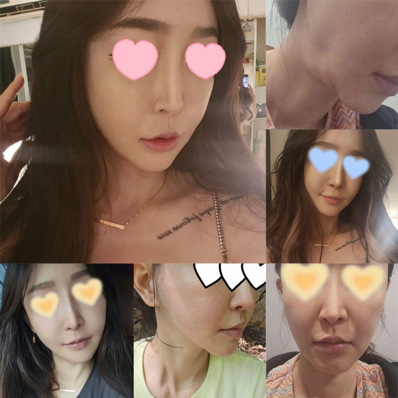 #안면거상(목) #지방이식(얼굴) #앞광대보혀물제거 #보톡스(자갈턱,침샘)