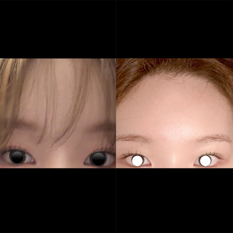 #2040이마거상 #눈(앞트임(재),뒤트임)
