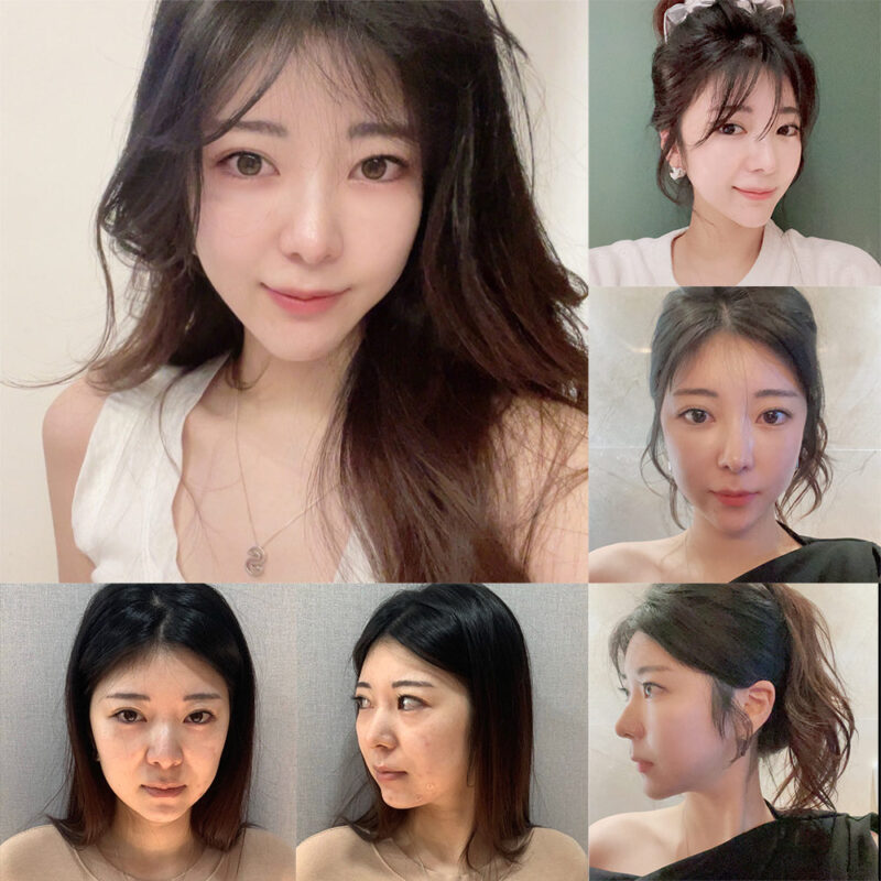 #광대축소#턱끝전진#앞턱보형물제거#2040미드업리프팅#눈밑지방재배치#지방이식#인디언밴드절제