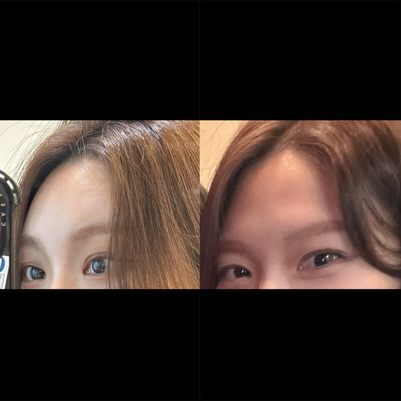 #2040이마거상#눈썹뼈절삭